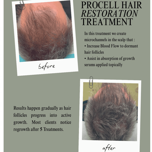 Hair Restoration Package at Jocelyn Brooks Aesthetics in Las Vegas, NV